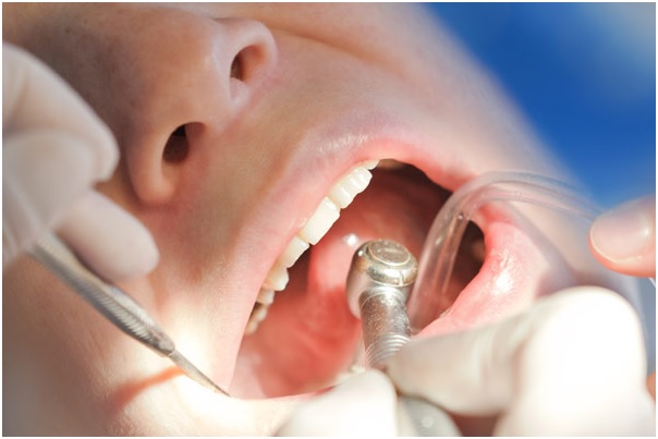 When a Dental Emergency Occurs, What to Do? 2