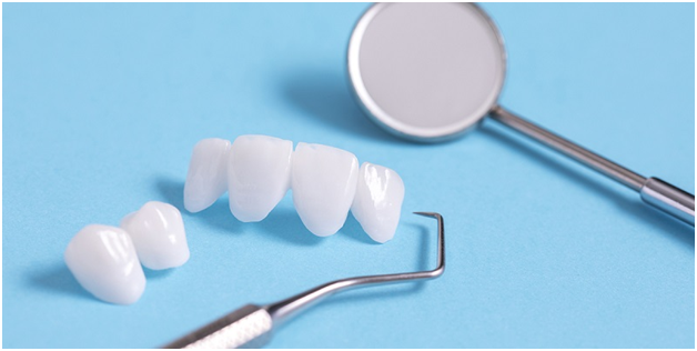 Features of All-Ceramic Dental Veneers 2