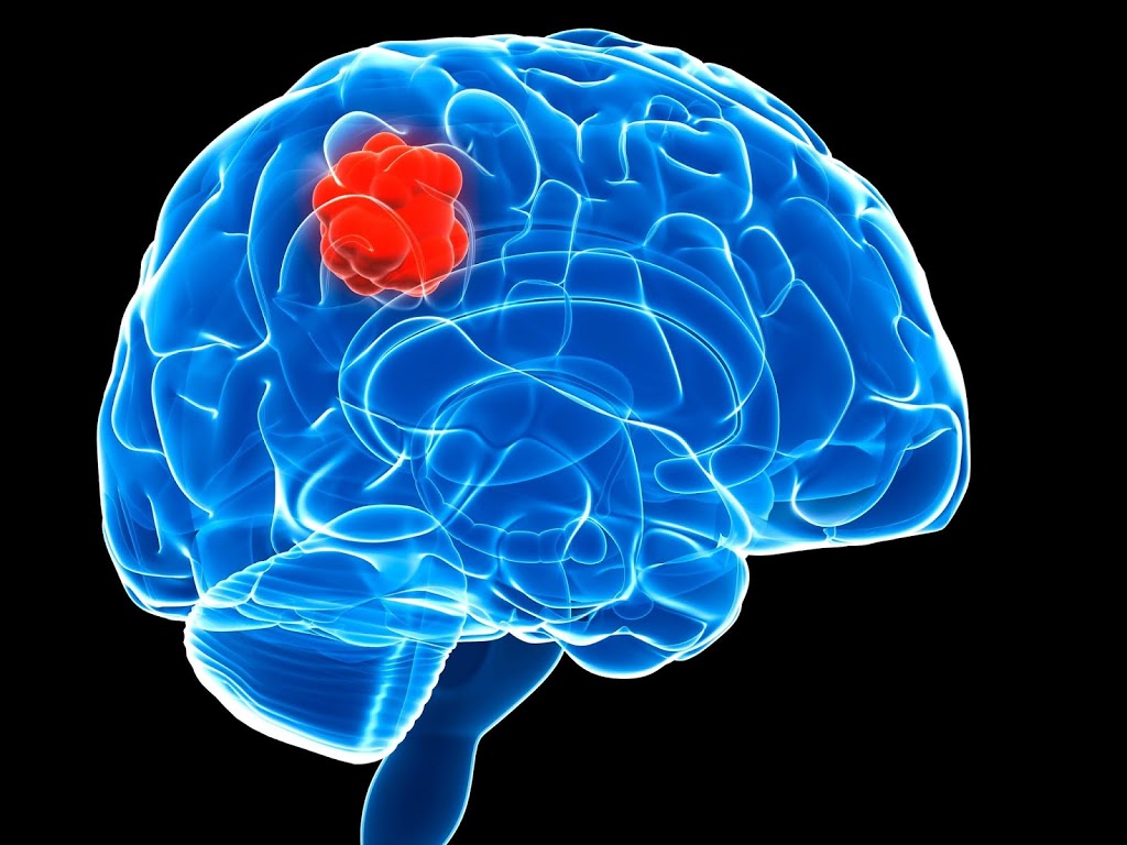 diagnosis-and-different-types-of-brain-tumor-surgery-that-you-should