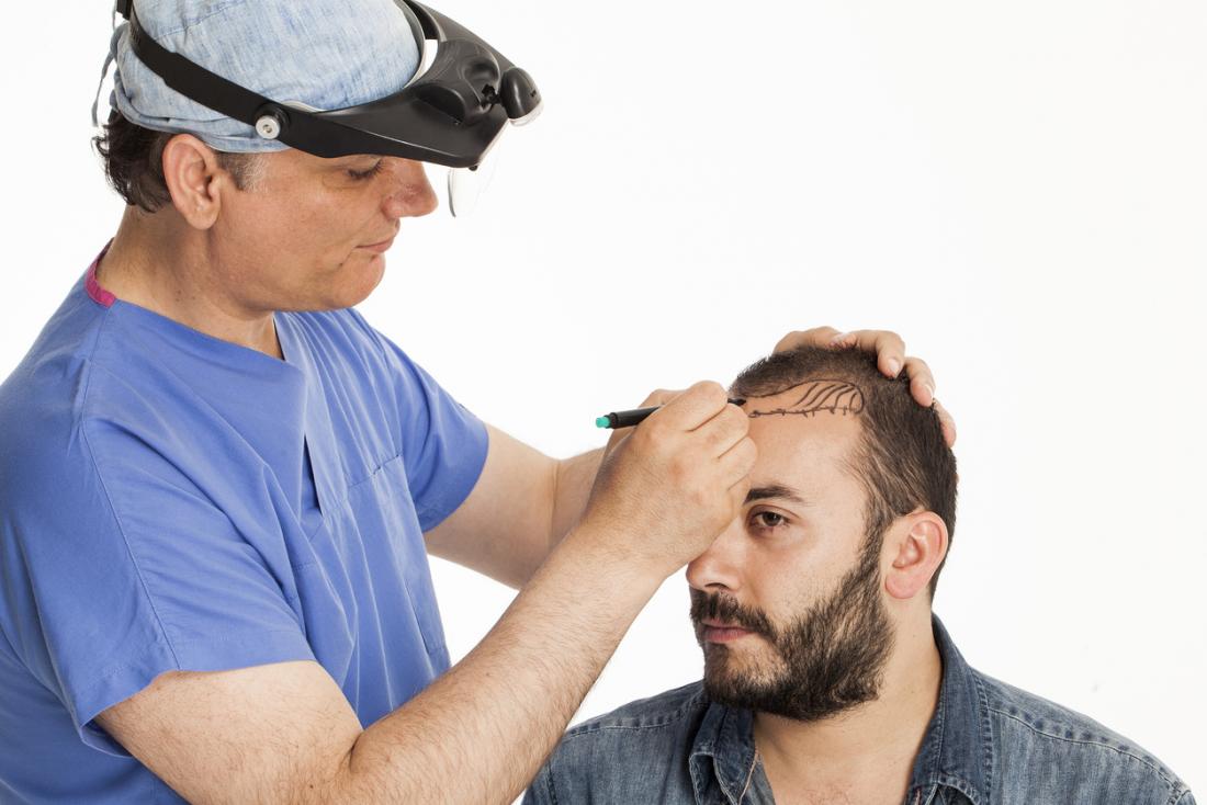 Getting A Hair Transplant Is Cheaper And More Effective Now 1