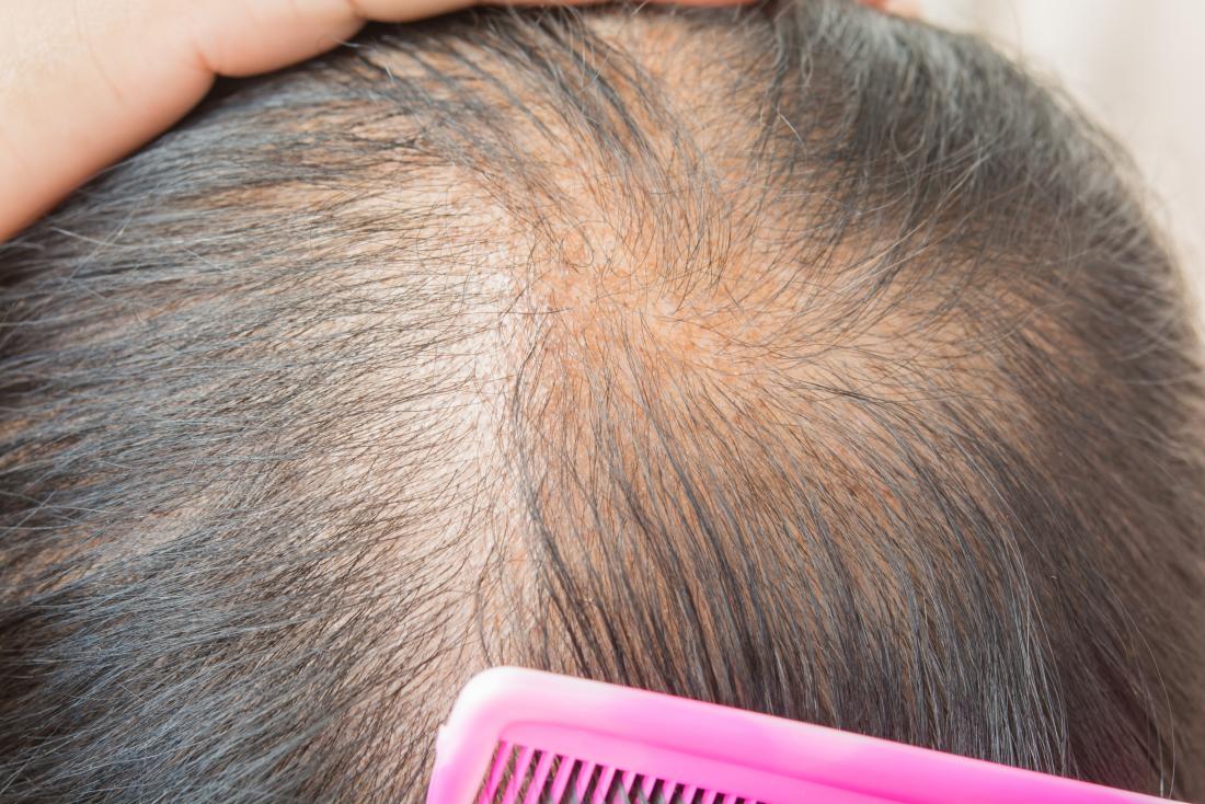 What is the best Solution for recovering Alopecia?