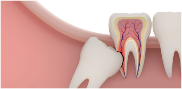 How to Know If You Need Wisdom Tooth Extraction? 1