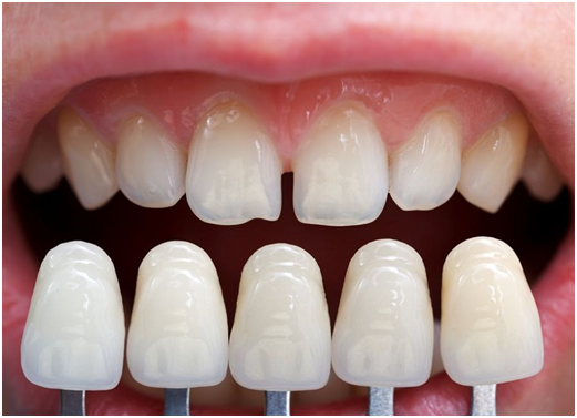 Features of All-Ceramic Dental Veneers 1