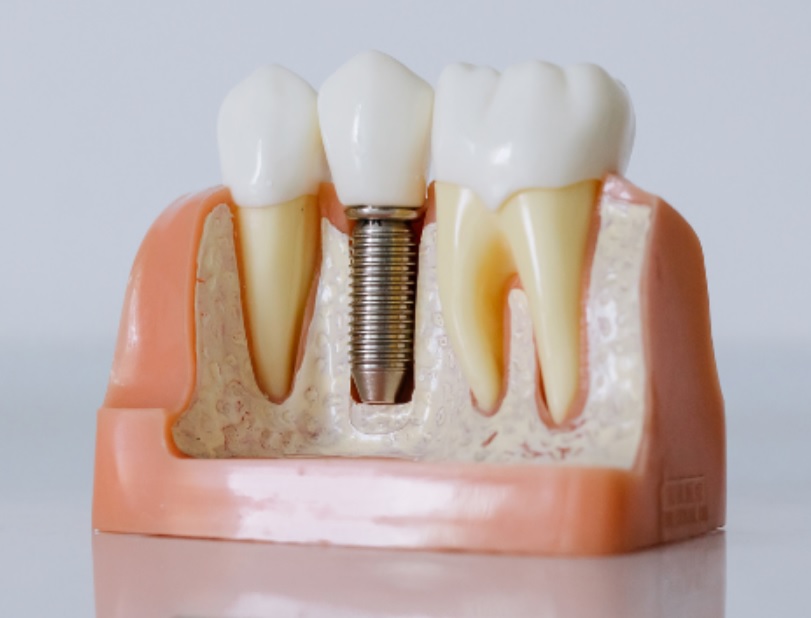 What Factors Can Impact the Success Rate of the Implant Process? 5